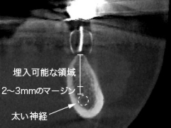 下の顎のインプラント_埋入可能領域